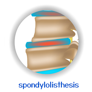 image of Oxford spondylolisthesis